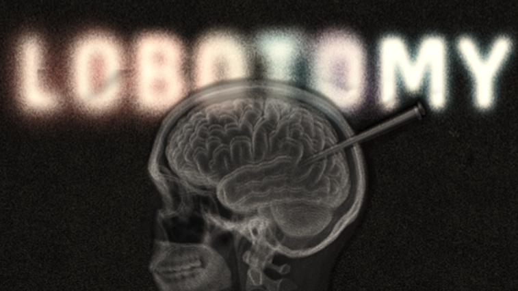 Lobotomy